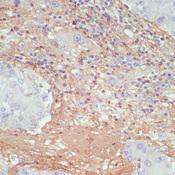 COL1A1 / Collagen I Alpha 1 Antibody - Immunohistochemistry of paraffin-embedded Human liver cancer using COL1A1 Polyclonal Antibody at dilution of 1:200 (40x lens).