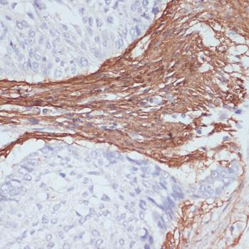 COL1A1 / Collagen I Alpha 1 Antibody - Immunohistochemistry of paraffin-embedded Human lung cancer using COL1A1 Polyclonal Antibody at dilution of 1:200 (40x lens).