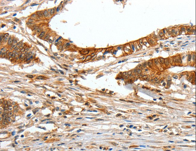 COL1A2 / Collagen I Alpha 2 Antibody - Immunohistochemistry of paraffin-embedded Human lung cancer using COL1A2 Polyclonal Antibody at dilution of 1:70.