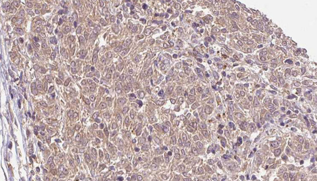 COL1A2 / Collagen I Alpha 2 Antibody - 1:100 staining human Melanoma tissue by IHC-P. The sample was formaldehyde fixed and a heat mediated antigen retrieval step in citrate buffer was performed. The sample was then blocked and incubated with the antibody for 1.5 hours at 22°C. An HRP conjugated goat anti-rabbit antibody was used as the secondary.