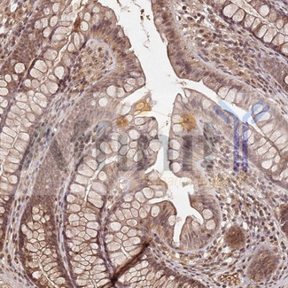 COL1A2 / Collagen I Alpha 2 Antibody - 1/100 staining human colon cancer tissue by IHC-P. The sample was formaldehyde fixed and a heat mediated antigen retrieval step in citrate buffer was performed. The sample was then blocked and incubated with the antibody for 1.5 hours at 22°C. An HRP conjugated goat anti-rabbit antibody was used as the secondary antibody.