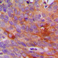 COL1A2 / Collagen I Alpha 2 Antibody - Immunohistochemical analysis of Collagen 1 alpha 2 staining in human breast cancer formalin fixed paraffin embedded tissue section. The section was pre-treated using heat mediated antigen retrieval with sodium citrate buffer (pH 6.0). The section was then incubated with the antibody at room temperature and detected using an HRP conjugated compact polymer system. DAB was used as the chromogen. The section was then counterstained with hematoxylin and mounted with DPX.
