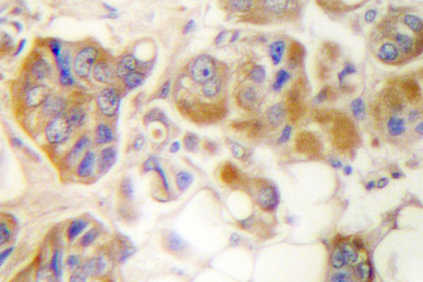 COL1A2 / Collagen I Alpha 2 Antibody - IHC of Collagen I (S3) pAb in paraffin-embedded human breast carcinoma tissue.