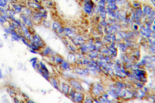 COL1A2 / Collagen I Alpha 2 Antibody - IHC of COL1A2 (T501) pAb in paraffin-embedded human colon carcinoma tissue.