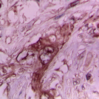 COL2A1 / Collagen II Alpha 1 Antibody - Immunohistochemical analysis of Collagen 2 alpha 1 staining in human breast cancer formalin fixed paraffin embedded tissue section. The section was pre-treated using heat mediated antigen retrieval with sodium citrate buffer (pH 6.0). The section was then incubated with the antibody at room temperature and detected using an HRP conjugated compact polymer system. DAB was used as the chromogen. The section was then counterstained with hematoxylin and mounted with DPX. w