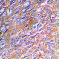 COL3A1 / Collagen III Antibody - Immunohistochemical analysis of Collagen 3 alpha 1 staining in human breast cancer formalin fixed paraffin embedded tissue section. The section was pre-treated using heat mediated antigen retrieval with sodium citrate buffer (pH 6.0). The section was then incubated with the antibody at room temperature and detected using an HRP conjugated compact polymer system. DAB was used as the chromogen. The section was then counterstained with hematoxylin and mounted with DPX.