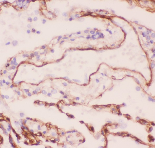 COL4A1 / Collagen IV Alpha1 Antibody - Collagen IV antibody IHC-paraffin: Human Lung Cancer Tissue.
