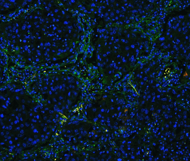 COL4A1 / Collagen IV Alpha1 Antibody - IF analysis of COL4A1 using anti-COL4A1 antibody COL4A1 was detected in paraffin-embedded section of human lung cancer tissues. Heat mediated antigen retrieval was performed in citrate buffer (pH6, epitope retrieval solution ) for 20 mins. The tissue section was blocked with 10% goat serum. The tissue section was then incubated with 1µg/mL rabbit anti-COL4A1 Antibody overnight at 4°C. Biotin conjugated goat anti-rabbit IgG was used as secondary antibody and incubated for 30 minutes at 37°C. The tissue section was developed using DyLight®488 Conjugated Avidin (BA1128). The section was counterstained with DAPI. Visualize using a fluorescence microscope and filter sets appropriate for the label used.