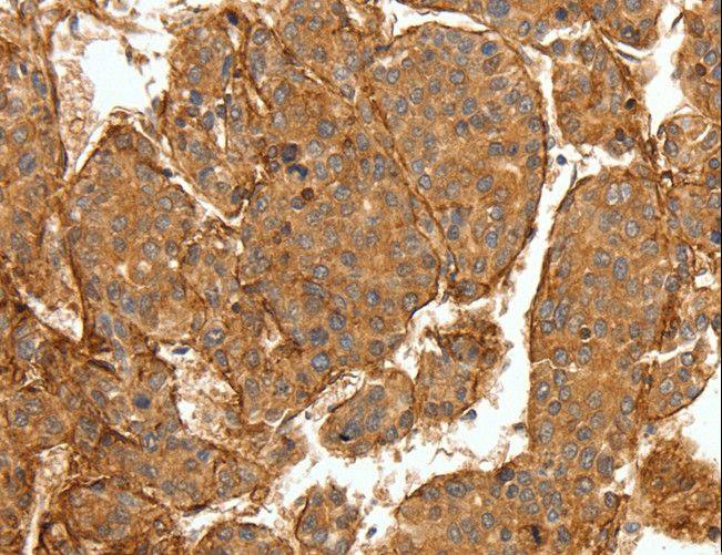 COL4A1 / Collagen IV Alpha1 Antibody - Immunohistochemistry of paraffin-embedded Human breast cancer using COL4A1 Polyclonal Antibody at dilution of 1:30.