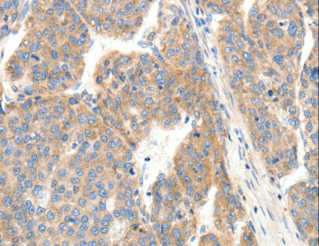 COL4A1 / Collagen IV Alpha1 Antibody - Immunohistochemistry of paraffin-embedded Human breast cancer using COL4A1 Polyclonal Antibody at dilution of 1:30.