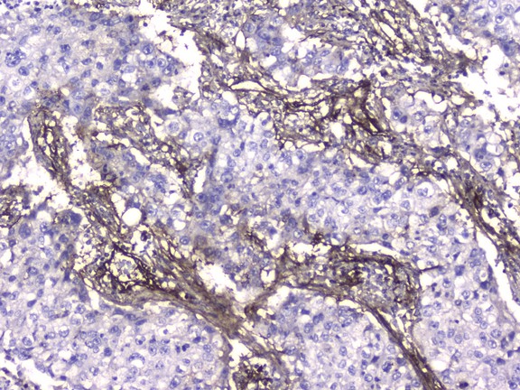 COL4A1 / Collagen IV Alpha1 Antibody - IHC analysis of Collagen IV using anti-Collagen IV antibody. Collagen IV was detected in paraffin-embedded section of human lung cancer tissue. Heat mediated antigen retrieval was performed in citrate buffer (pH6, epitope retrieval solution) for 20 mins. The tissue section was blocked with 10% goat serum. The tissue section was then incubated with 2µg/ml mouse anti-Collagen IV Antibody overnight at 4°C. Biotinylated goat anti-mouse IgG was used as secondary antibody and incubated for 30 minutes at 37°C. The tissue section was developed using Strepavidin-Biotin-Complex (SABC) with DAB as the chromogen.