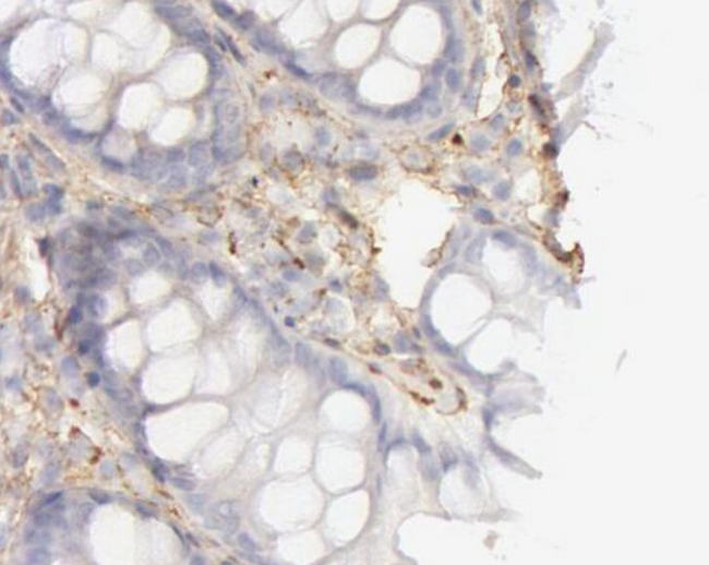 COL4A1 / Collagen IV Alpha1 Antibody - 1/100 staining human colon cancer tissue by IHC-P. The sample was formaldehyde fixed and a heat mediated antigen retrieval step in citrate buffer was performed. The sample was then blocked and incubated with the antibody for 1.5 hours at 22°C. An HRP conjugated goat anti-rabbit antibody was used as the secondary antibody.