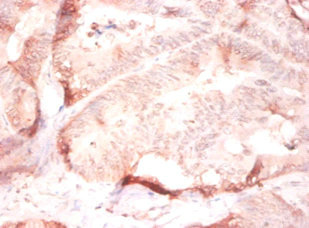 COL4A2 / Collagen IV Alpha2 Antibody - Immunohistochemistry of paraffin-embedded human colon cancer using COL4A2 Antibody at dilution of 1:50