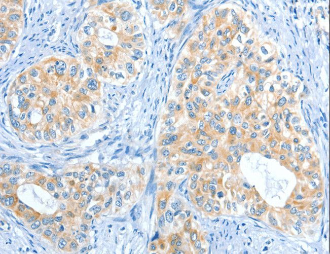 COL4A2 / Collagen IV Alpha2 Antibody - Immunohistochemistry of paraffin-embedded Human cervical cancer using COL4A2 Polyclonal Antibody at dilution of 1:70.