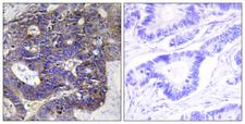 COL4A2 / Collagen IV Alpha2 Antibody - Peptide - + Immunohistochemistry analysis of paraffin-embedded human colon carcinoma tissue using Collagen IV a2 antibody.