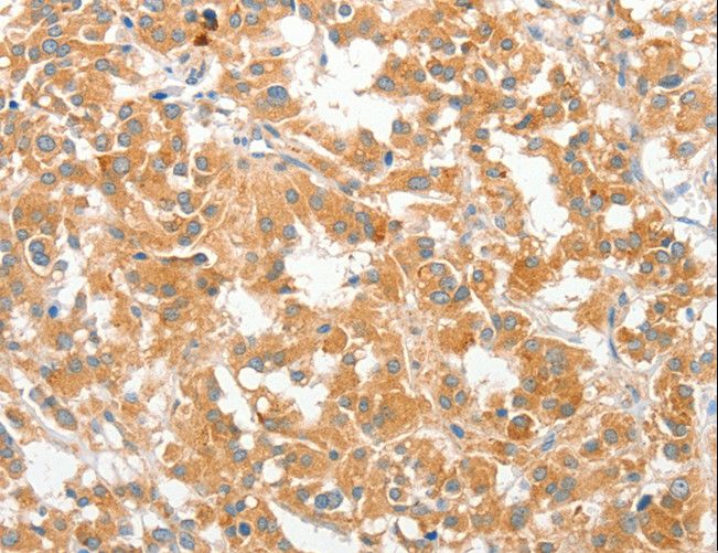 COL4A3BP / CERT Antibody - Immunohistochemistry of paraffin-embedded Human thyroid cancer using COL4A3BP Polyclonal Antibody at dilution of 1:60.