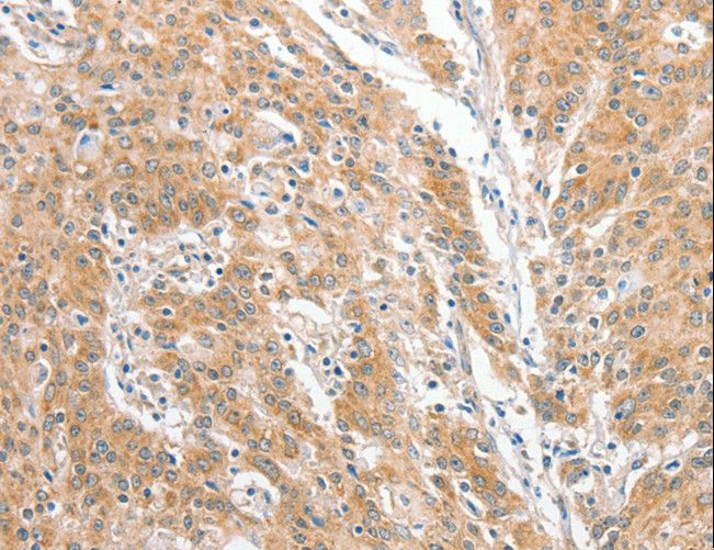 COL4A3BP / CERT Antibody - Immunohistochemistry of paraffin-embedded Human gastric cancer using COL4A3BP Polyclonal Antibody at dilution of 1:60.