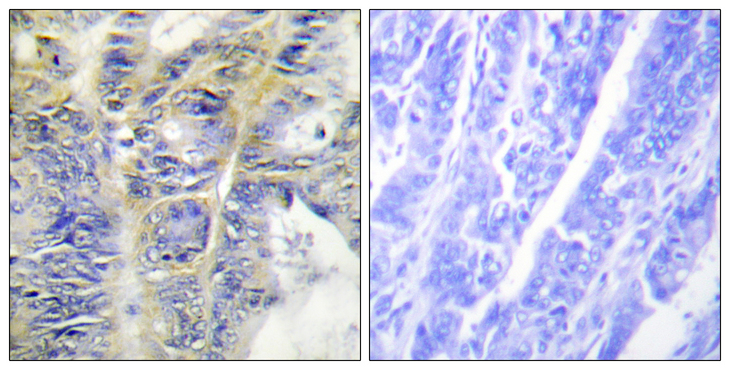 COL4A5 / Collagen IV Alpha5 Antibody - Immunohistochemistry analysis of paraffin-embedded human colon carcinoma tissue, using Collagen IV alpha5 Antibody. The picture on the right is blocked with the synthesized peptide.