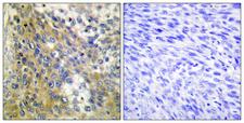 COL4A6 / Collagen IV Antibody - Immunohistochemistry analysis of paraffin-embedded human cervix carcinoma tissue, using Collagen IV alpha6 Antibody. The picture on the right is blocked with the synthesized peptide.