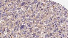 COL4A6 / Collagen IV Antibody - 1:100 staining human Melanoma tissue by IHC-P. The sample was formaldehyde fixed and a heat mediated antigen retrieval step in citrate buffer was performed. The sample was then blocked and incubated with the antibody for 1.5 hours at 22°C. An HRP conjugated goat anti-rabbit antibody was used as the secondary.