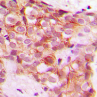 COL5A1 / Collagen V Alpha 1 Antibody - Immunohistochemical analysis of Collagen 5 alpha 1 staining in human breast cancer formalin fixed paraffin embedded tissue section. The section was pre-treated using heat mediated antigen retrieval with sodium citrate buffer (pH 6.0). The section was then incubated with the antibody at room temperature and detected using an HRP conjugated compact polymer system. DAB was used as the chromogen. The section was then counterstained with hematoxylin and mounted with DPX.