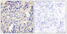 COL5A2 / Collagen V Alpha 2 Antibody - Peptide - + Immunohistochemistry analysis of paraffin-embedded human breast carcinoma tissue using Collagen V a2 antibody.