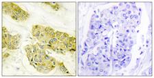 COL5A3 / Collagen V Alpha 3 Antibody - Peptide - + Immunohistochemistry analysis of paraffin-embedded human breast carcinoma tissue using Collagen V a3 antibody.