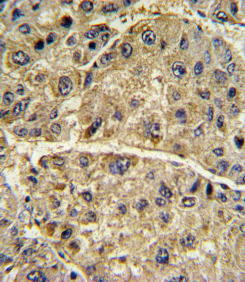 COL6A1 / Collagen VI Alpha 1 Antibody - Formalin-fixed and paraffin-embedded human hepatocarcinoma with COL6A1 Antibody , which was peroxidase-conjugated to the secondary antibody, followed by DAB staining. This data demonstrates the use of this antibody for immunohistochemistry; clinical relevance has not been evaluated.