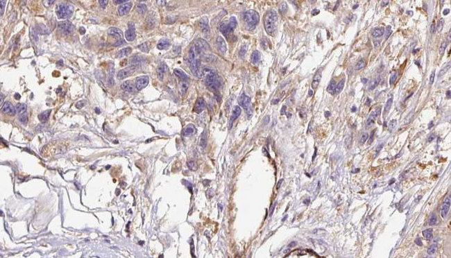 COL6A1 / Collagen VI Alpha 1 Antibody - 1:100 staining human Melanoma tissue by IHC-P. The sample was formaldehyde fixed and a heat mediated antigen retrieval step in citrate buffer was performed. The sample was then blocked and incubated with the antibody for 1.5 hours at 22°C. An HRP conjugated goat anti-rabbit antibody was used as the secondary.