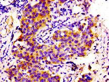 COL6A2 / Collagen VI Alpha 2 Antibody - Immunohistochemistry image of paraffin-embedded human bladder cancer at a dilution of 1:100