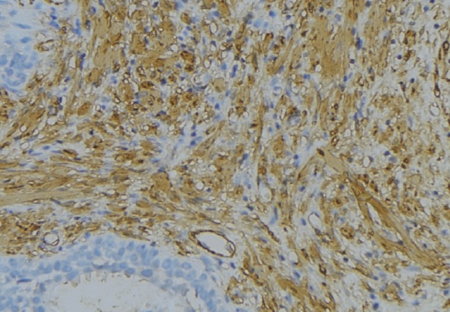 COL6A2 / Collagen VI Alpha 2 Antibody - 1:100 staining human uterus tissue by IHC-P. The sample was formaldehyde fixed and a heat mediated antigen retrieval step in citrate buffer was performed. The sample was then blocked and incubated with the antibody for 1.5 hours at 22°C. An HRP conjugated goat anti-rabbit antibody was used as the secondary.
