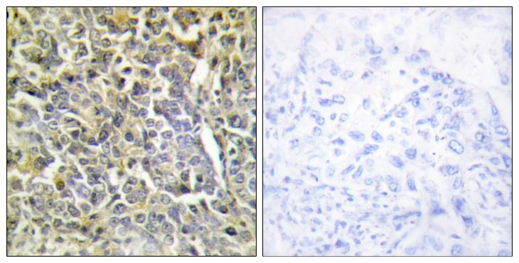 COL6A2 / Collagen VI Alpha 2 Antibody - Peptide - + Immunohistochemistry analysis of paraffin-embedded human lung carcinoma tissue using Collagen VI a2 antibody.