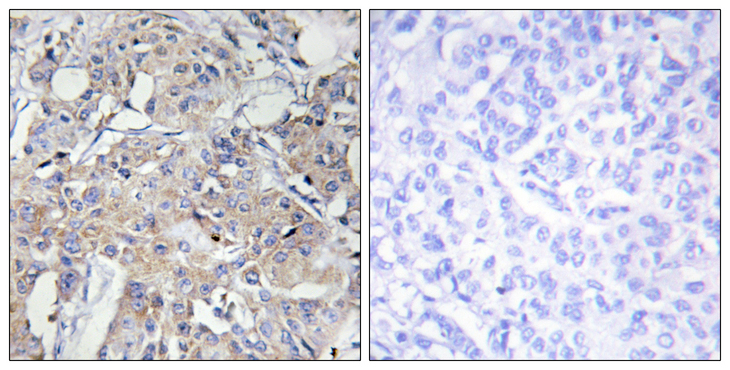 COL6A3 / Collagen VI Alpha 3 Antibody - Immunohistochemistry analysis of paraffin-embedded human breast carcinoma tissue, using Collagen VI alpha3 Antibody. The picture on the right is blocked with the synthesized peptide.