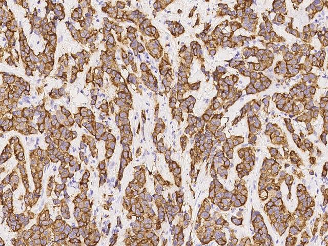 COL9A1 / Collagen IX Antibody - Immunochemical staining of human COL9A1 in human breast carcinoma with rabbit polyclonal antibody at 1:1000 dilution, formalin-fixed paraffin embedded sections.