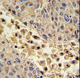COLEC11 Antibody - Formalin-fixed and paraffin-embedded human hepatocarcinoma with COLEC11 Antibody , which was peroxidase-conjugated to the secondary antibody, followed by DAB staining. This data demonstrates the use of this antibody for immunohistochemistry; clinical relevance has not been evaluated.