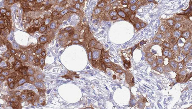 COLEC12 Antibody - 1:100 staining human Head and neck carcinoma tissue by IHC-P. The sample was formaldehyde fixed and a heat mediated antigen retrieval step in citrate buffer was performed. The sample was then blocked and incubated with the antibody for 1.5 hours at 22°C. An HRP conjugated goat anti-rabbit antibody was used as the secondary.