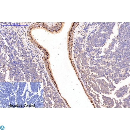 Collagen I Antibody - Immunohistochemical analysis of human-lung-cancer tissue. Anti-Collagen I at 1:200 (4°C, overnight). Antigen retrieval - Sodium Citrate pH6 (>98°C, 20min). Secondary - 1:200 (room temp, 30min). Negative control - Secondary only