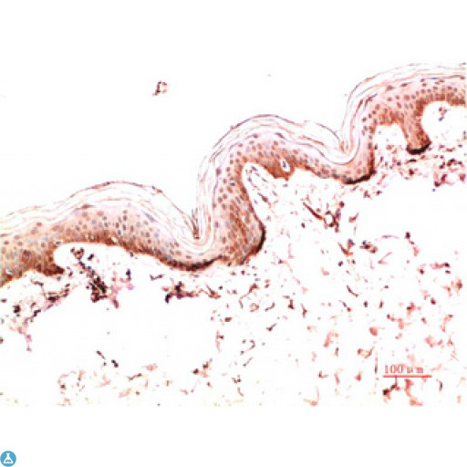 Collagen I Antibody - Immunohistochemical analysis of paraffin-embedded Human Colon Carcinoma Tissue using Collagen I Mouse monoclonal antibody diluted at 1:200.