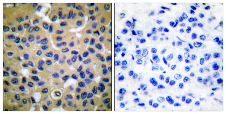 Collagen II Antibody - Peptide - + Immunohistochemical analysis of paraffin-embedded human breast carcinoma tissue using Collagen II antibody.