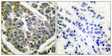 Collagen IV Antibody - Immunohistochemistry analysis of paraffin-embedded human breast carcinoma tissue, using Collagen IV Antibody. The picture on the right is blocked with the synthesized peptide.