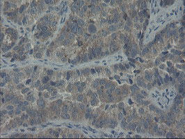 COMMD1 Antibody - IHC of paraffin-embedded Adenocarcinoma of Human ovary tissue using anti-COMMD1 mouse monoclonal antibody. (Heat-induced epitope retrieval by 10mM citric buffer, pH6.0, 100C for 10min).