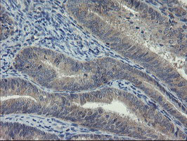 COMMD1 Antibody - IHC of paraffin-embedded Adenocarcinoma of Human endometrium tissue using anti-COMMD1 mouse monoclonal antibody. (Heat-induced epitope retrieval by 10mM citric buffer, pH6.0, 100C for 10min).