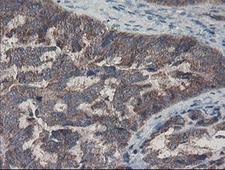 COMMD1 Antibody - IHC of paraffin-embedded Adenocarcinoma of Human ovary tissue using anti-COMMD1 mouse monoclonal antibody.