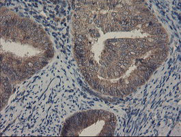COMMD1 Antibody - IHC of paraffin-embedded Adenocarcinoma of Human endometrium tissue using anti-COMMD1 mouse monoclonal antibody.