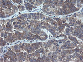 COMMD1 Antibody - IHC of paraffin-embedded Adenocarcinoma of Human ovary tissue using anti-COMMD1 mouse monoclonal antibody. (Heat-induced epitope retrieval by 10mM citric buffer, pH6.0, 100C for 10min).