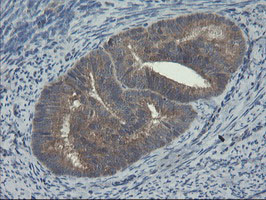 COMMD1 Antibody - IHC of paraffin-embedded Adenocarcinoma of Human endometrium tissue using anti-COMMD1 mouse monoclonal antibody.