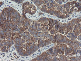 COMMD1 Antibody - IHC of paraffin-embedded Adenocarcinoma of Human ovary tissue using anti-COMMD1 mouse monoclonal antibody.