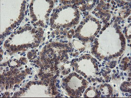 COMMD1 Antibody - IHC of paraffin-embedded Carcinoma of Human thyroid tissue using anti-COMMD1 mouse monoclonal antibody.
