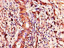 COMMD1 Antibody - Immunohistochemistry of paraffin-embedded human gastric cancer using COMMD1 Antibody at dilution of 1:100