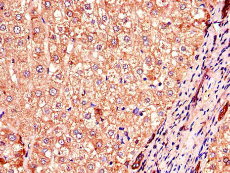 COMMD1 Antibody - Immunohistochemistry of paraffin-embedded human liver cancer using COMMD1 Antibody at dilution of 1:100